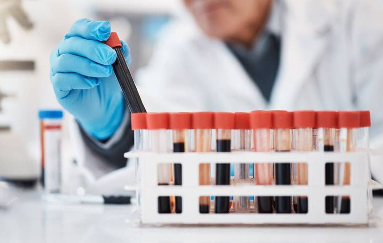 Albumin/Globulin Ratio Below 0.8: Low Value Guide