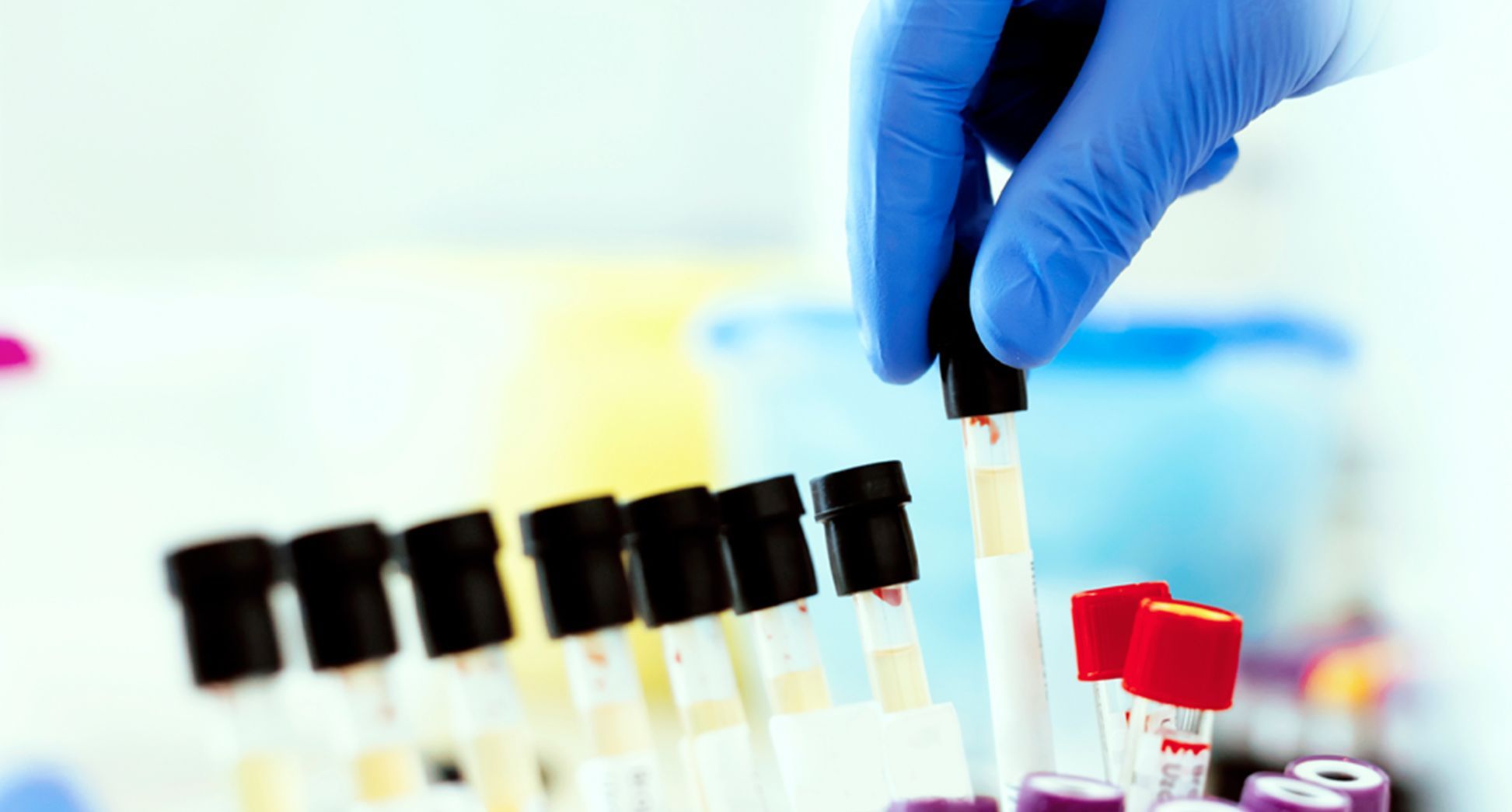BUN/Creatinine Ratio Results Explained