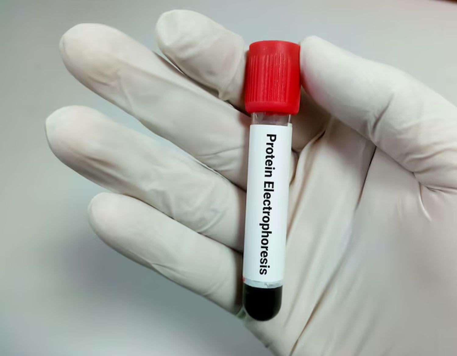 Protein Electrophoresis Test Results: Complete Guide