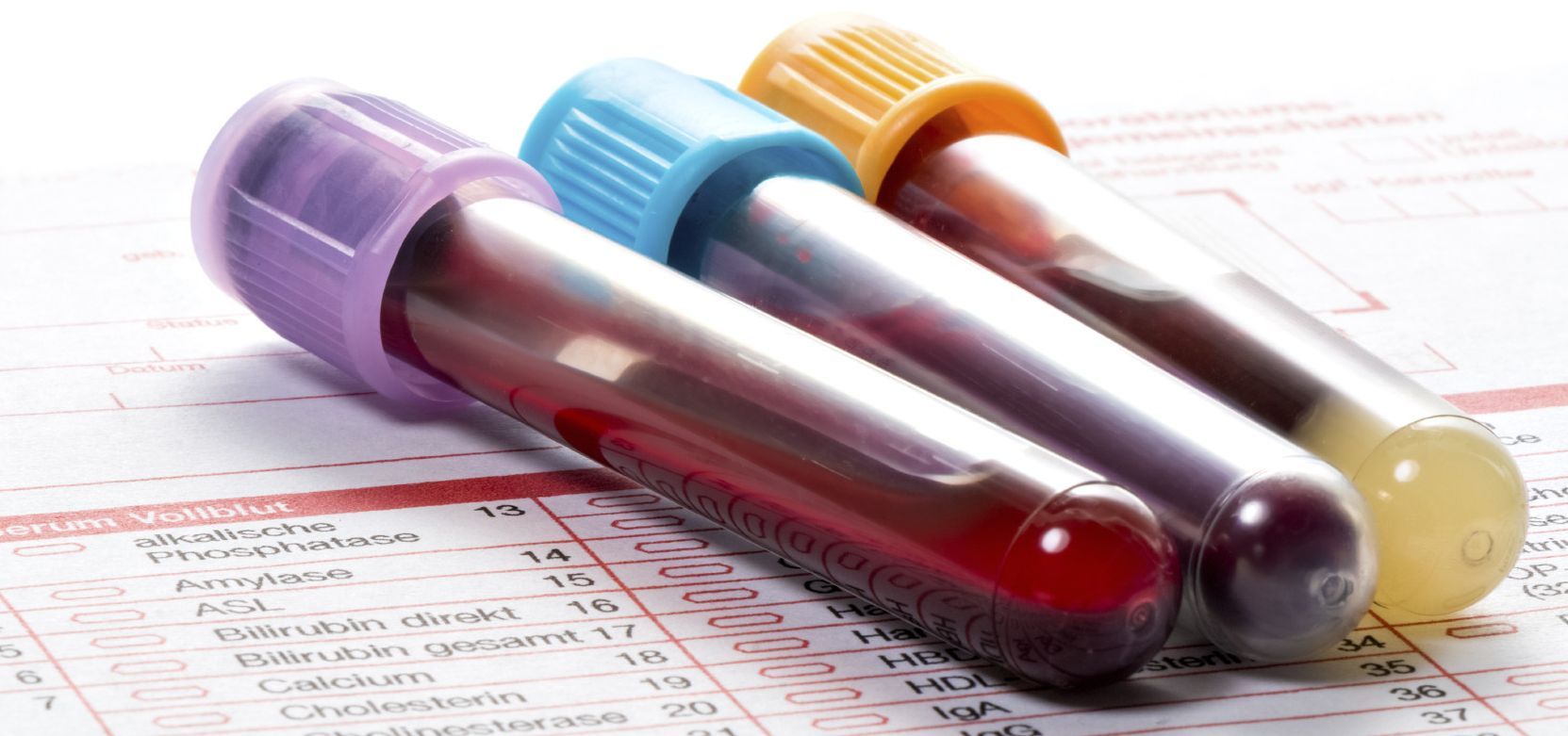 Albumin/Creatinine Ratio (ACR) Test Results