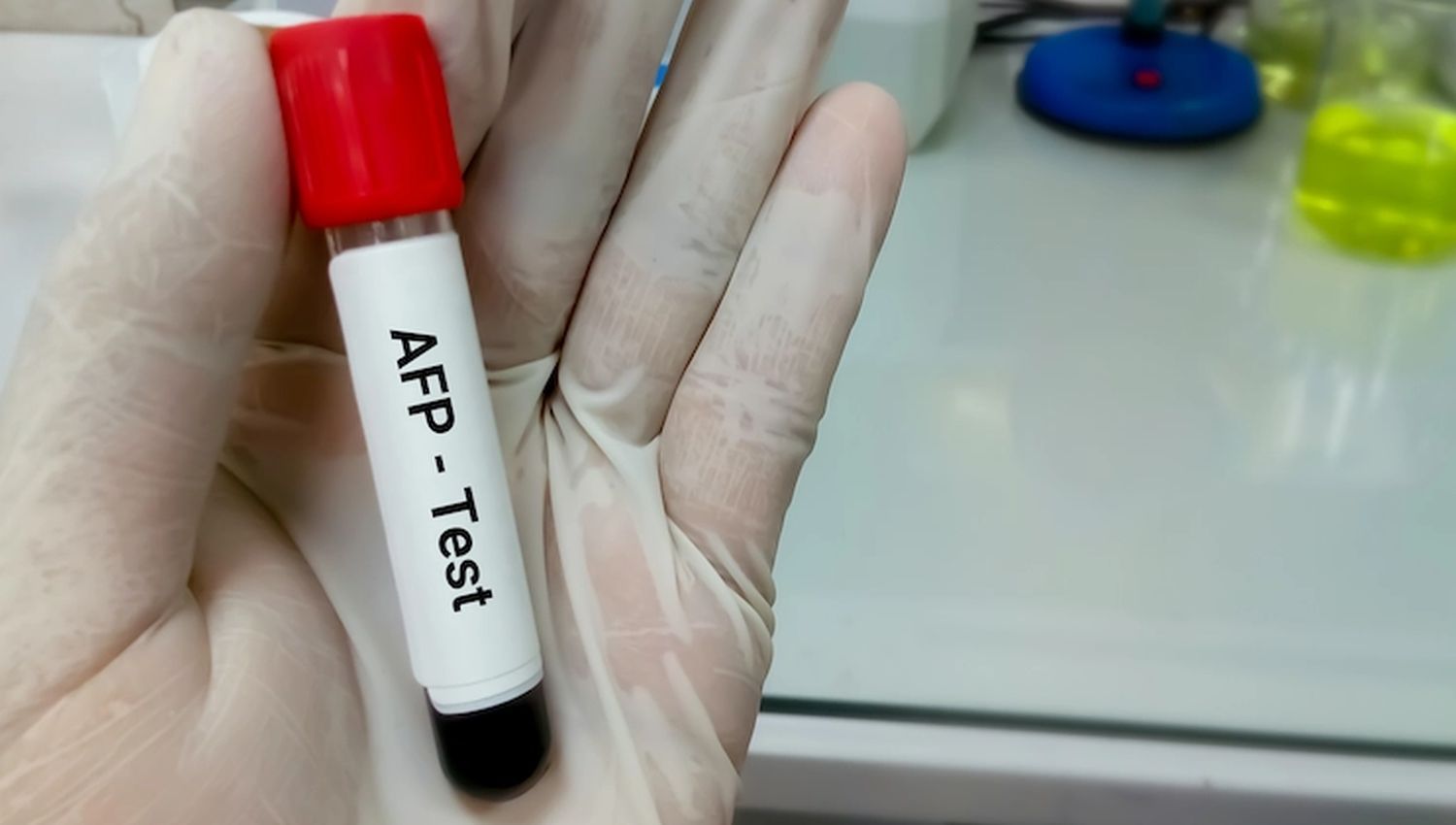 AFP Tumor Marker Results: Liver Cancer Screening Guide