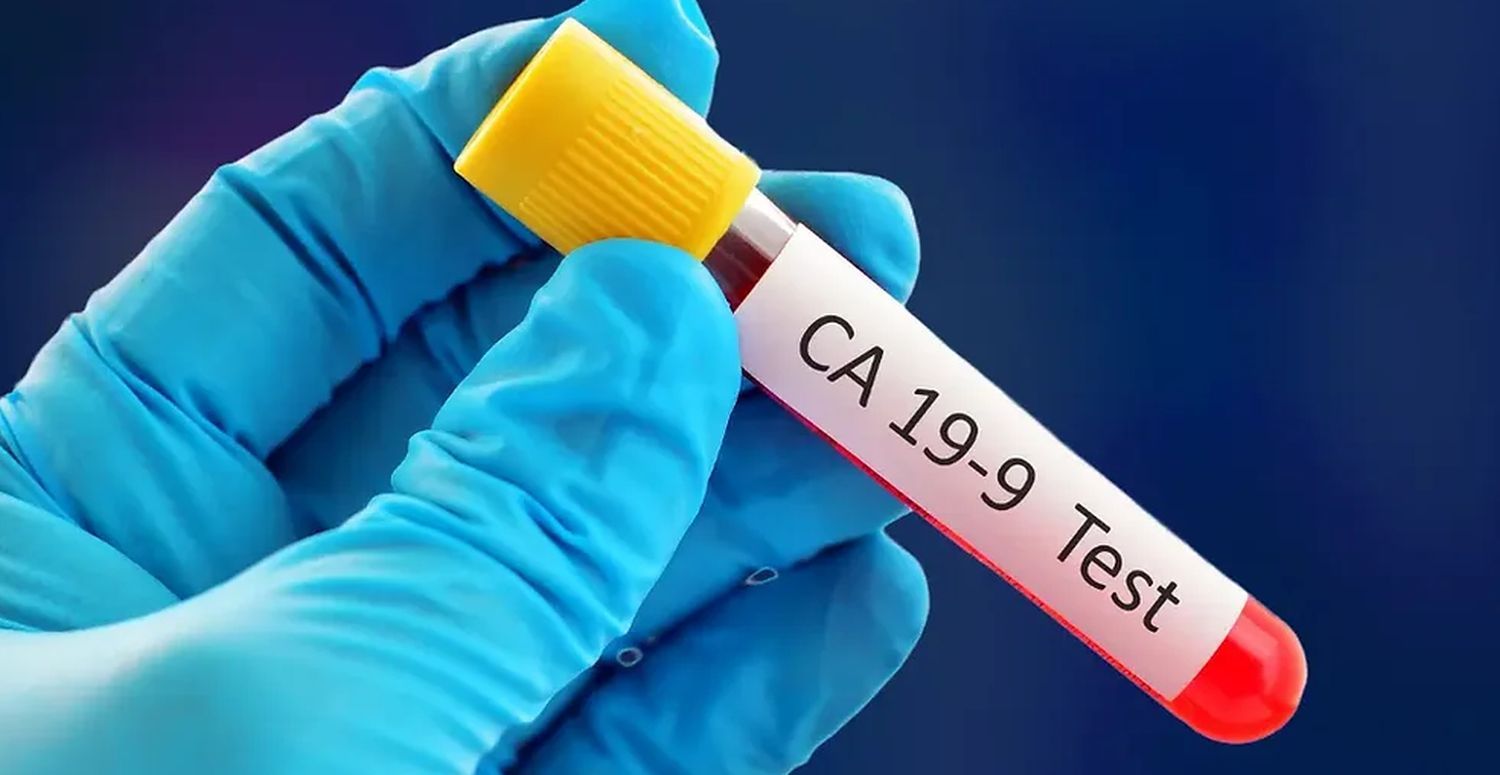 CA 19-9 Pancreatic Cancer Marker: Abnormal Results Guide
