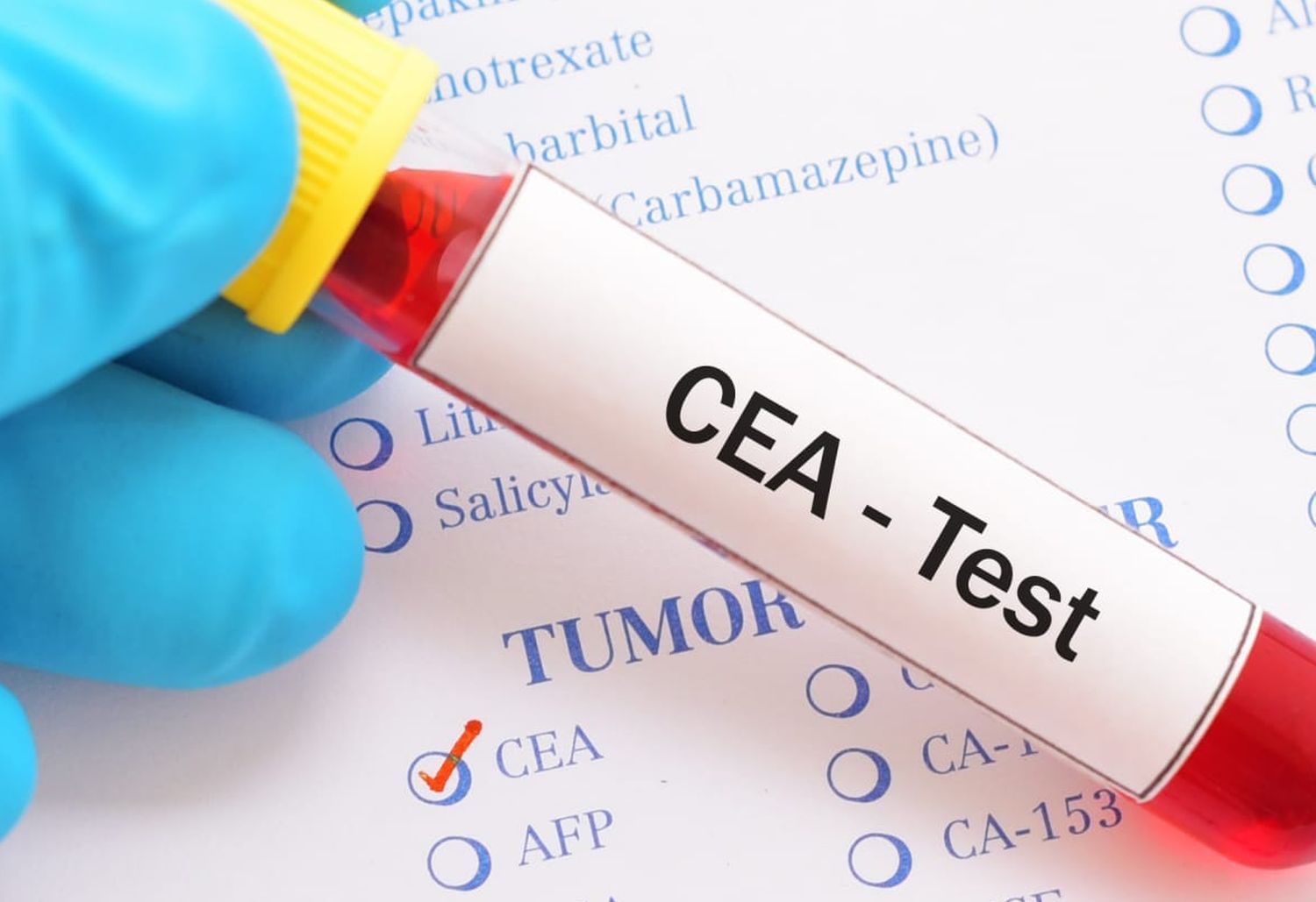 CEA Tumor Marker Test Results: Complete Interpretation Guide
