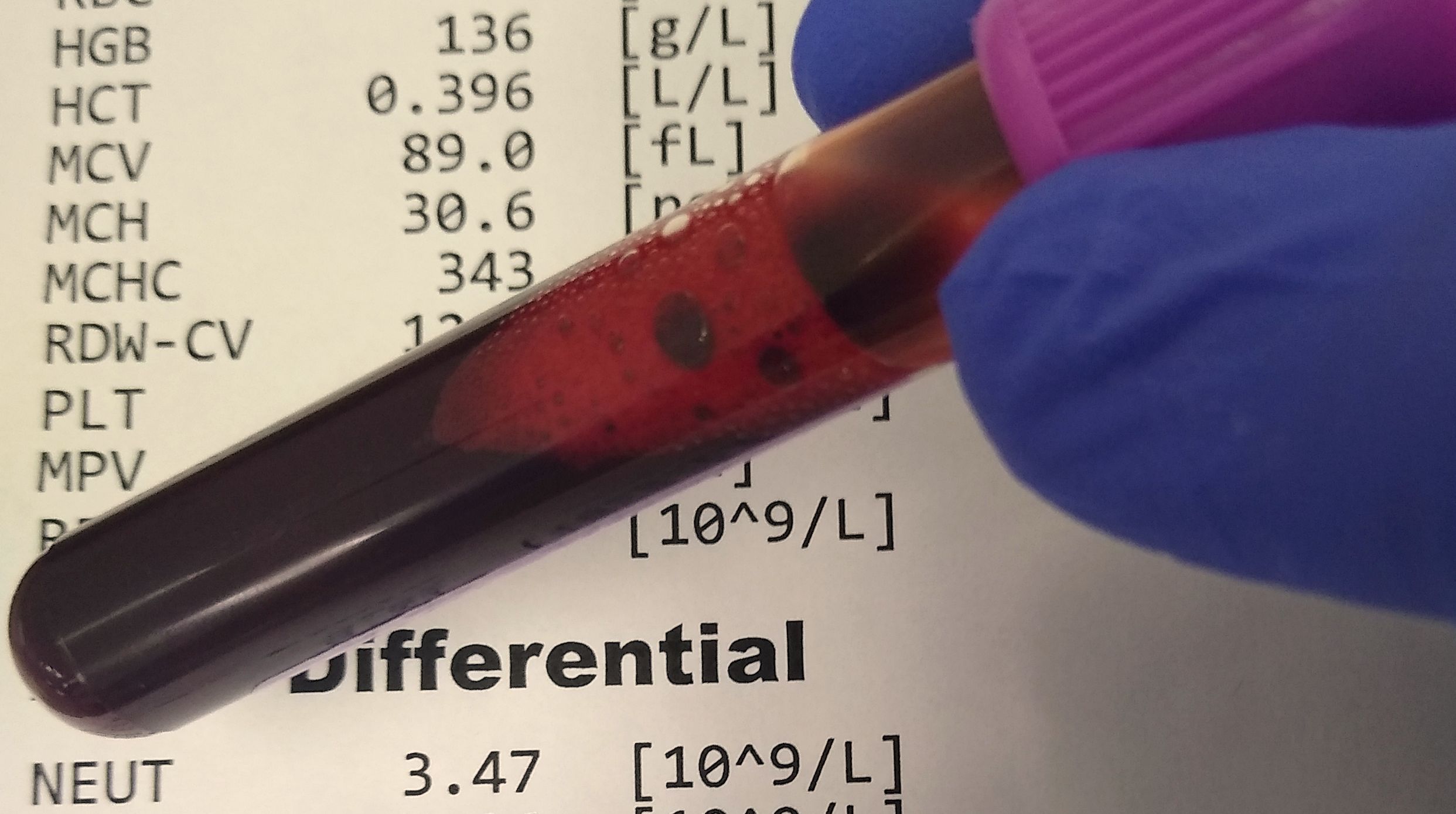 Mean Platelet Volume (MPV) in Blood Work: Complete Analysis Guide