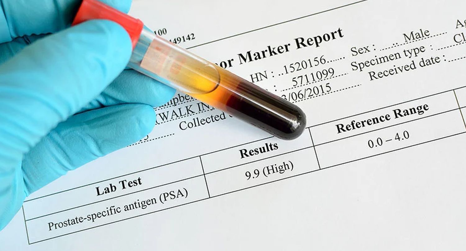 Understanding Elevated PSA Test Results: Complete Guide